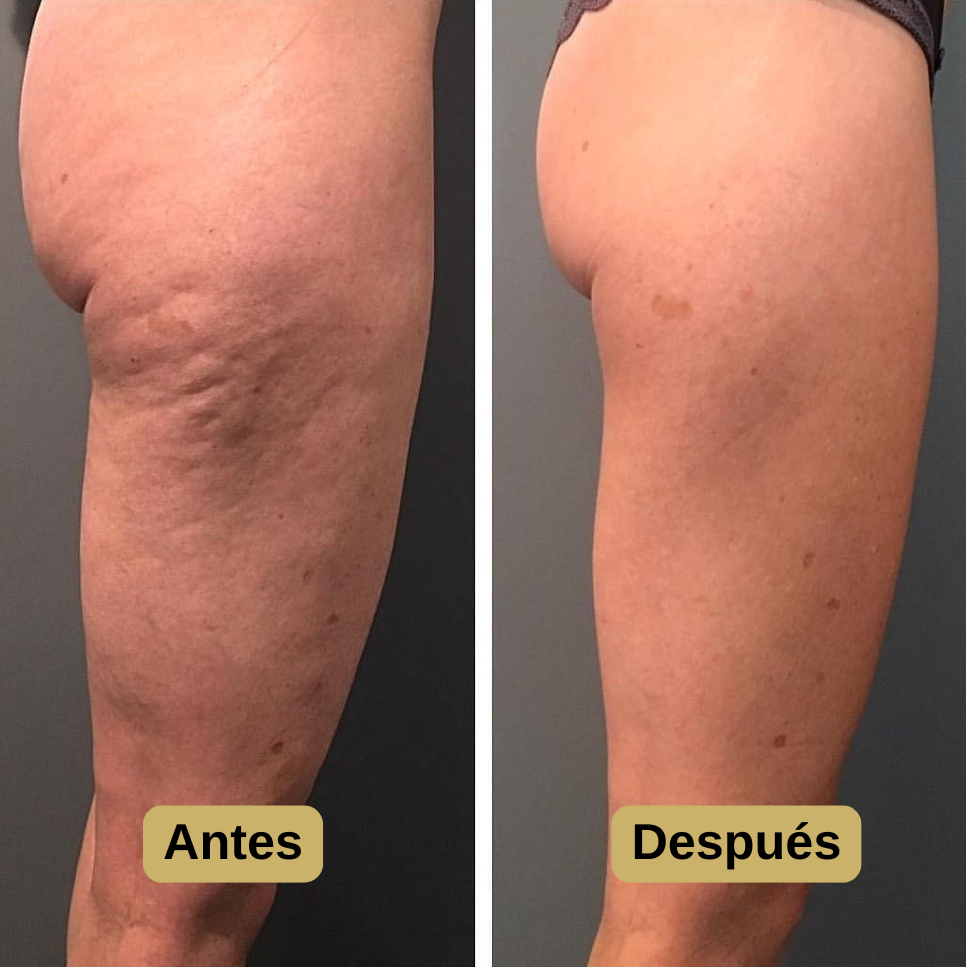 DERMALUX™ Masajeador Anticelulítico